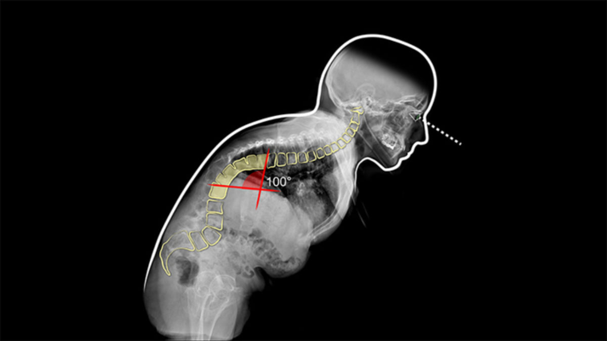 intervento vertebre schiena