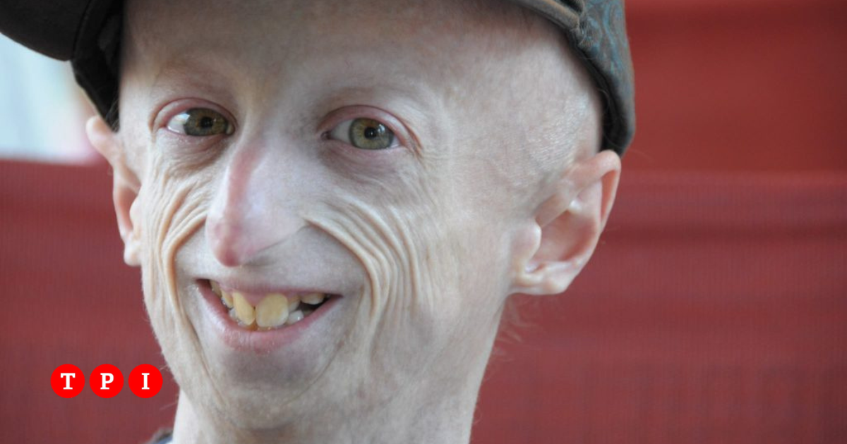 È morto Sammy Basso: aveva 28 anni. Era il più longevo malato al mondo di progeria